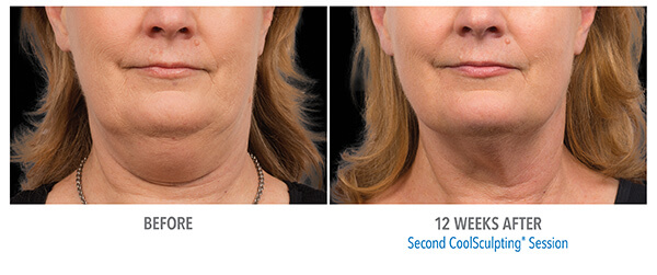 Before and after 01. Neck. 12 weeks after