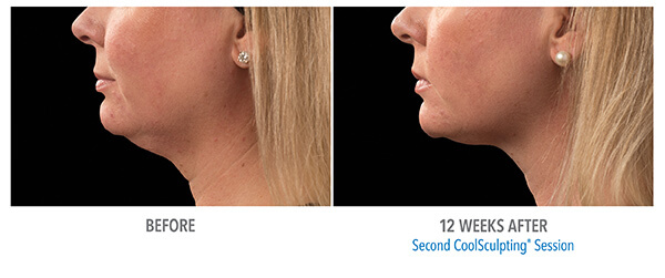 Before and after 05. Neck. 12 weeks after