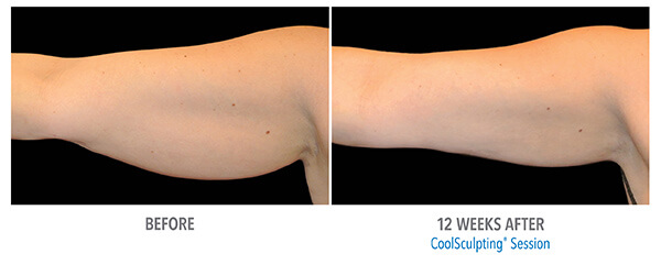 Before and after 07. Arms. 12 weeks after